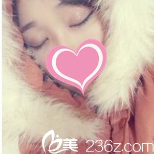 术后1个月双眼皮闭眼无痕 术后1个月双眼皮闭眼无痕