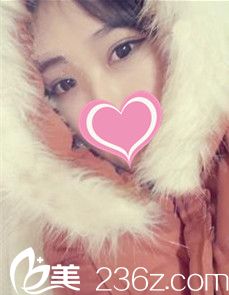 在廊坊华康花4380元做韩式双眼皮后由内双变魅力大眼