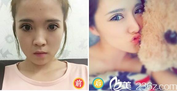 马文章医生的玻尿酸隆鼻<span style= 马文章医生的玻尿酸隆鼻<span style=