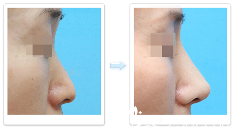 深圳非凡韩国医生李寒松鼻子整形案例