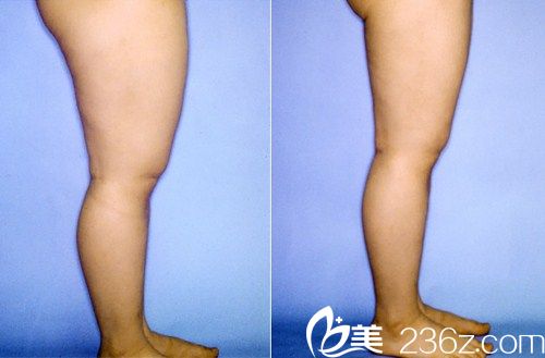 韩国江南三星整形医院   大腿吸脂前后对比图