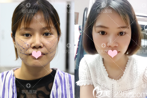 深圳非凡整形医院王永祥面部线雕提升案例 深圳非凡整形医院王永祥面部线雕提升案例