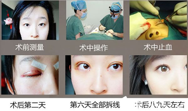 壹加壹分切双眼皮手术过程
