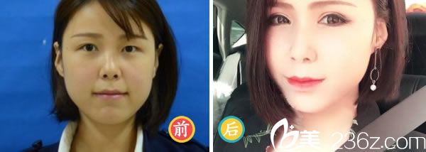 壹加壹双眼皮手术<span style=