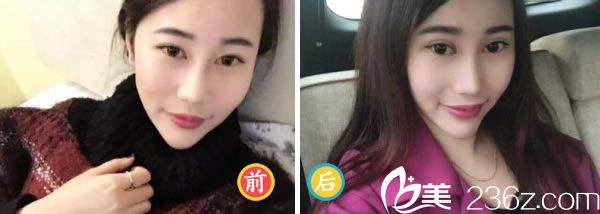 全切双眼皮50天的恢复<span style=