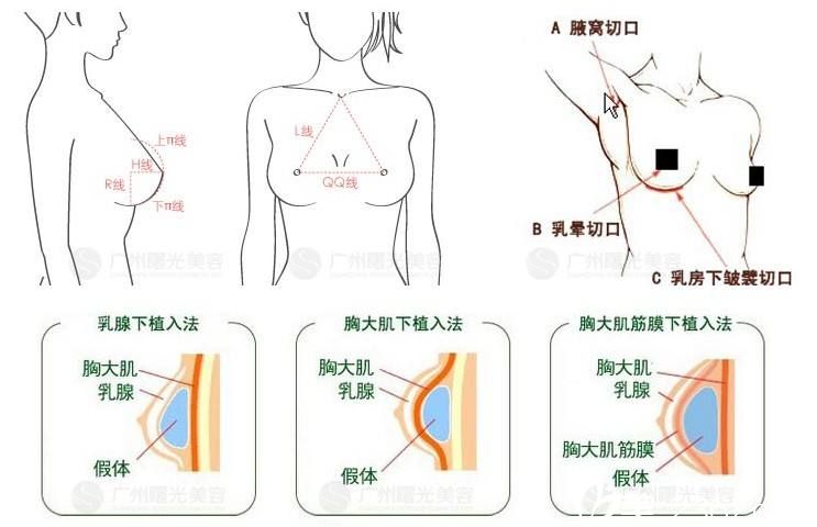 隆胸手术法