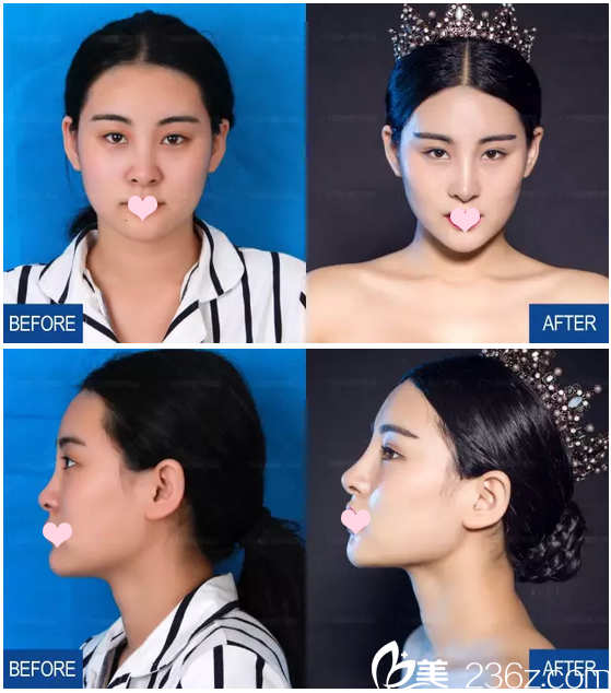 广州海峡隆鼻手术超好看