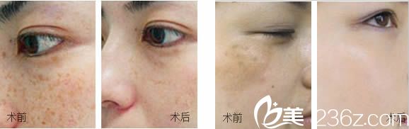 马志军祛斑案例图 马志军祛斑案例图