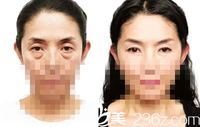 祛眼袋前后对比图 祛眼袋前后对比图
