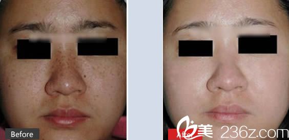闫侯旺祛斑前后对比案例 闫侯旺祛斑前后对比案例