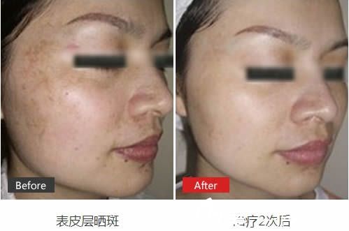王莹治疗晒斑案例效果对比图 王莹治疗晒斑案例效果对比图