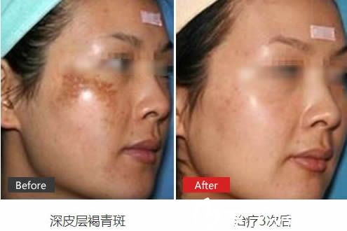 王莹治疗深皮层褐青斑3次术后效果图 王莹治疗深皮层褐青斑3次术后效果图