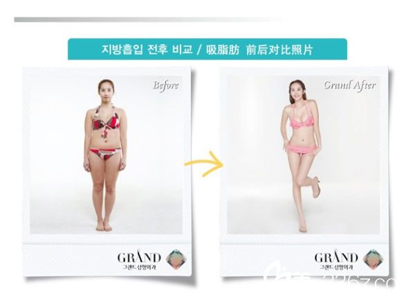 高兰得整形外科   吸脂前后对比图