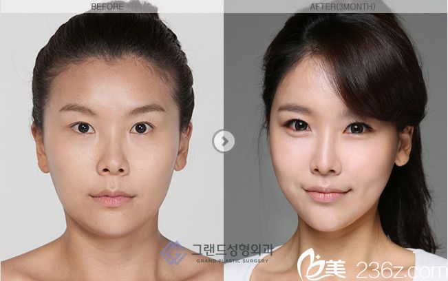 高兰得整形外科 面部轮廓前后对比图 高兰得整形外科 面部轮廓前后对比图
