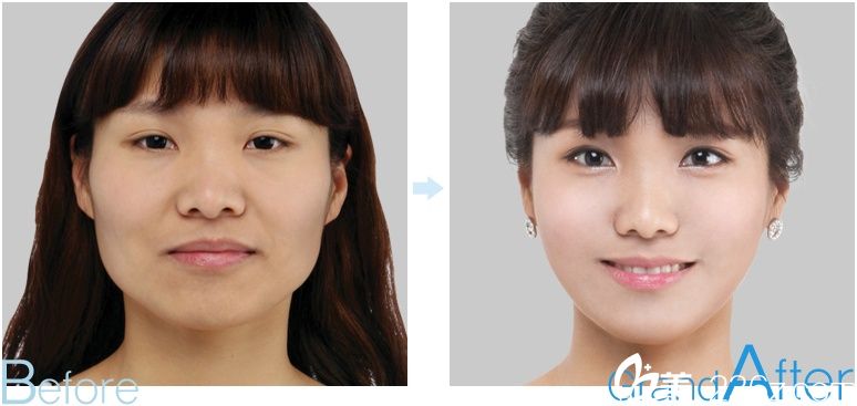  面部轮廓手术前后对比图  高兰得整形外科