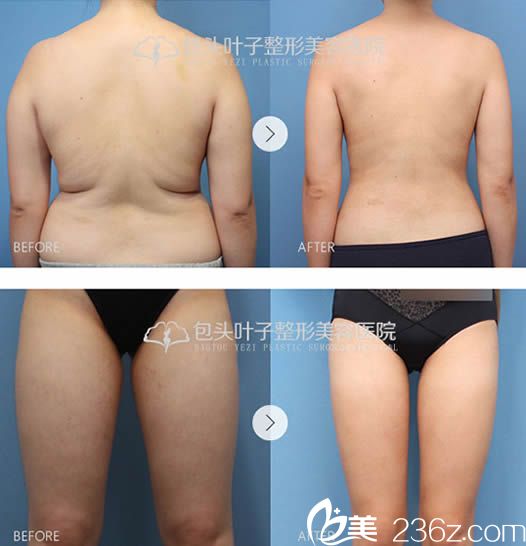 腰腹部和腿部吸脂瘦身案例图