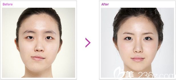 韩国高兰得整容外科眼睛双鄂整形对比图