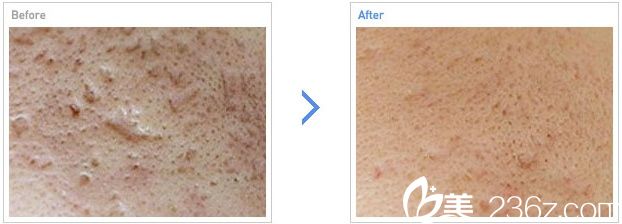 激光去除痤疮疤痕治疗前后对比照片