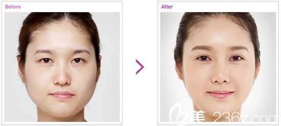 开眼角和双眼皮整形手术前后对比照片 开眼角和双眼皮整形手术前后对比照片