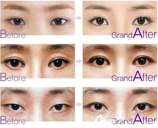  放低眼角手术前后对比照片