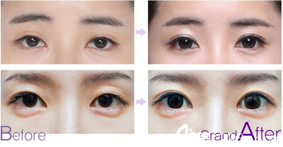 眼睛修复手术前后对比照片