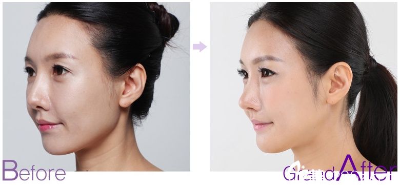 鼻子修复前后对比图