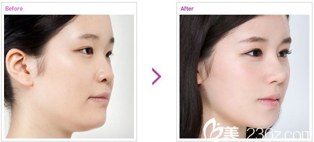 名品鼻子整形前后照片