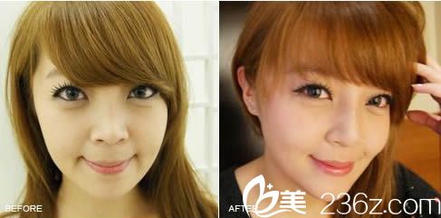 在包头丽人做膨体隆鼻前后对比效果图 在包头丽人做膨体隆鼻前后对比效果图