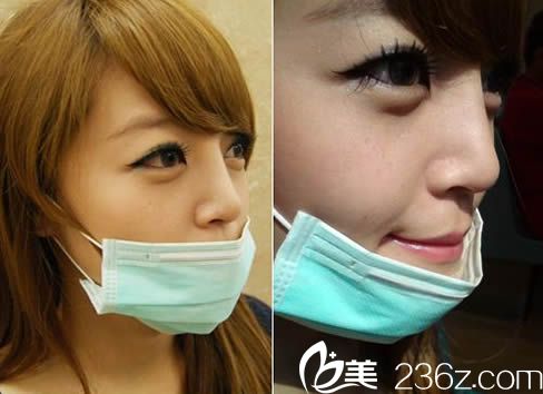 看我在包头丽人掏3.5万做膨体隆鼻+自体软骨垫鼻尖效果好不好