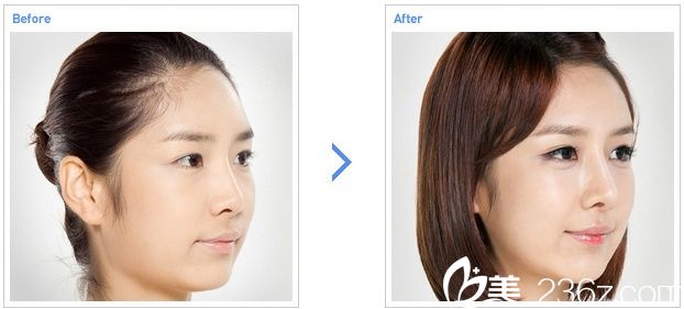 额头脂肪移植手术前后图 额头脂肪移植手术前后图