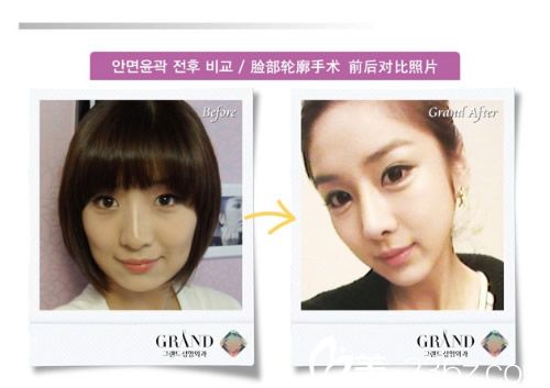 脸部轮廓手术前后照片 脸部轮廓手术前后照片