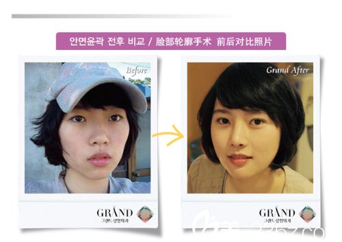 面部轮廓手术对比图 面部轮廓手术对比图
