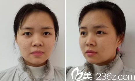 在瑞丽做鼻综合前的素颜照片 在瑞丽做鼻综合前的素颜照片