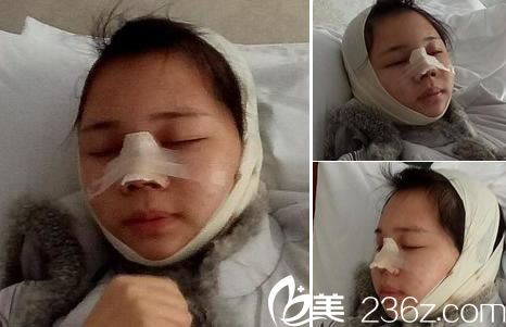 做完鼻综合手术当天照片 做完鼻综合手术当天照片