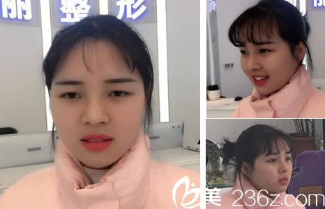 耳软骨隆鼻手术15天效果 耳软骨隆鼻手术15天效果