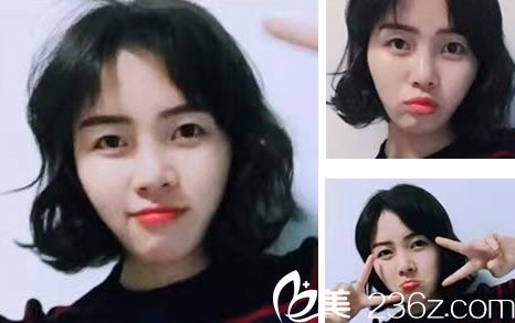 金华瑞丽做鼻综合效果怎么样 金华瑞丽做鼻综合效果怎么样