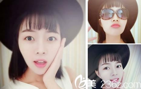 自体软骨隆鼻手术60天恢复照片 自体软骨隆鼻手术60天恢复照片