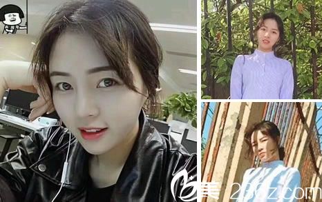 鼻综合整形手术80天效果怎么样 鼻综合整形手术80天效果怎么样