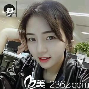 金华瑞丽整形好吗？【真人案例】邻家小妹分享做鼻综合80天效果与恢复过程图
