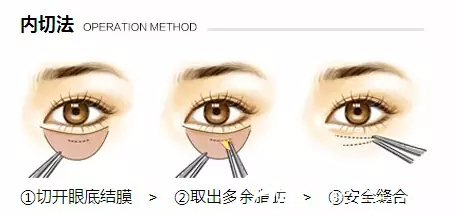 内切法祛眼袋适合于年轻人