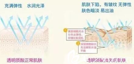 面部抗衰老应由无创到微创再到手术 面部抗衰老应由无创到微创再到手术