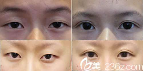 包头丽人双眼皮案例图