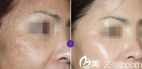 丽人激光祛斑前后对比效果