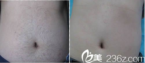 激光无痕脱毛真人案例图