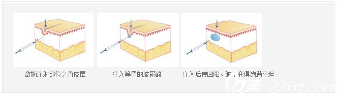 玻尿酸注射过程图