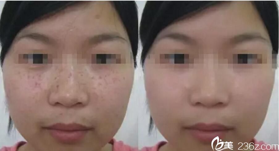 吴美珍 祛斑案例 吴美珍 祛斑案例