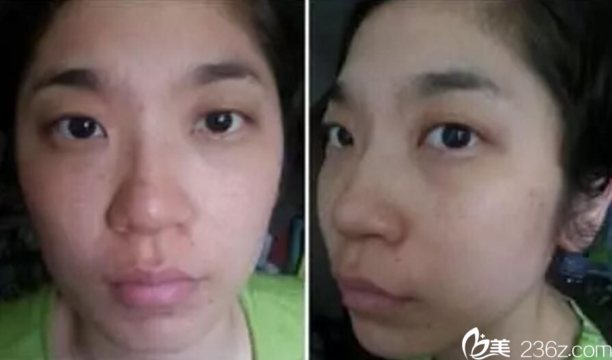 真实案例 吴美珍 激光美肤 真实案例 吴美珍 激光美肤