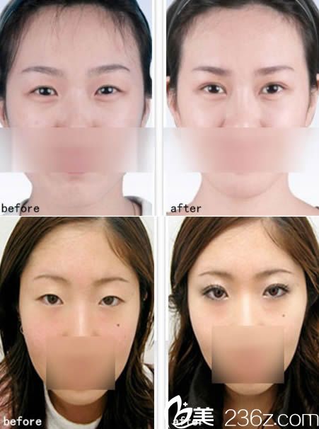 呼市大韩切开双眼皮案例效果图