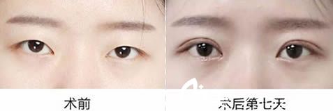 呼和浩特大韩医院韩式双眼皮案例