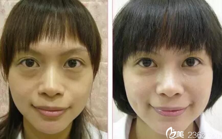 吴彩霞经典注射案例